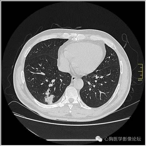 【病例】空腔型肺癌1例CT影像诊断与分析 【病例】空腔型肺癌1例CT影像诊断与分析