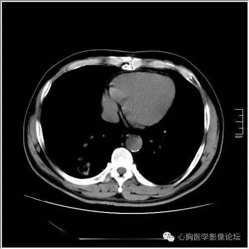 【病例】空腔型肺癌1例CT影像诊断与分析 【病例】空腔型肺癌1例CT影像诊断与分析