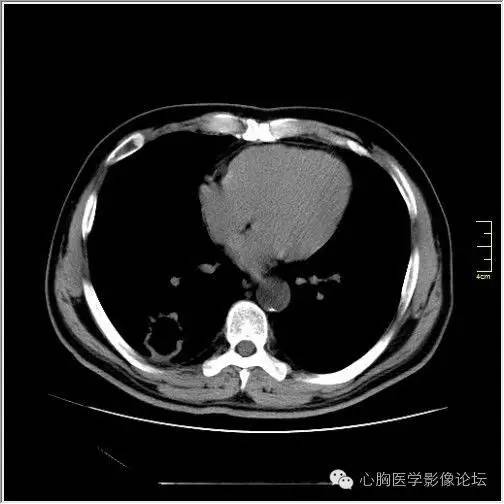 【病例】空腔型肺癌1例CT影像诊断与分析 【病例】空腔型肺癌1例CT影像诊断与分析