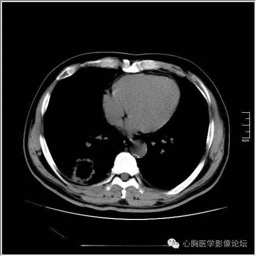 【病例】空腔型肺癌1例CT影像诊断与分析 【病例】空腔型肺癌1例CT影像诊断与分析
