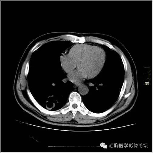 【病例】空腔型肺癌1例CT影像诊断与分析 【病例】空腔型肺癌1例CT影像诊断与分析