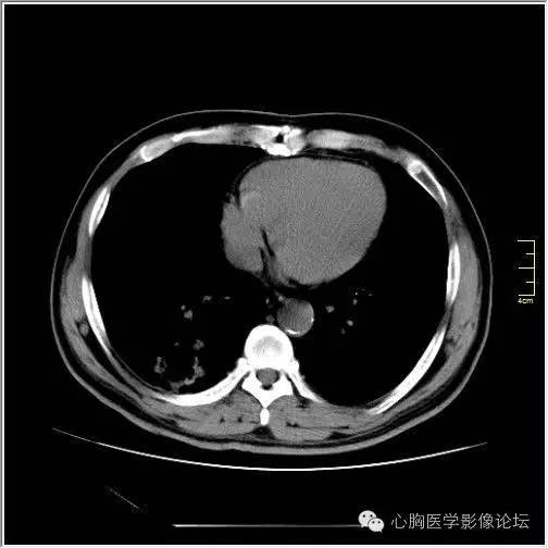 【病例】空腔型肺癌1例CT影像诊断与分析 【病例】空腔型肺癌1例CT影像诊断与分析