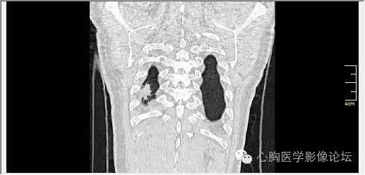 【病例】空腔型肺癌1例CT影像诊断与分析 【病例】空腔型肺癌1例CT影像诊断与分析
