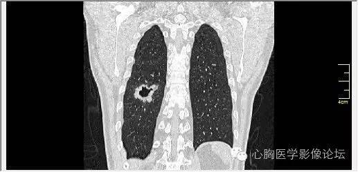 【病例】空腔型肺癌1例CT影像诊断与分析 【病例】空腔型肺癌1例CT影像诊断与分析