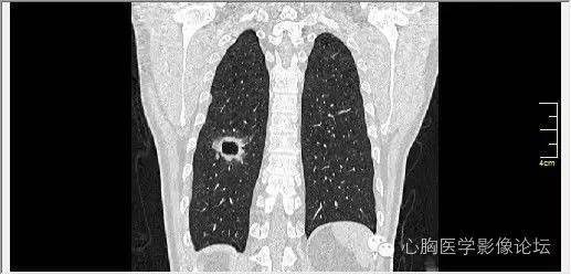 【病例】空腔型肺癌1例CT影像诊断与分析 【病例】空腔型肺癌1例CT影像诊断与分析