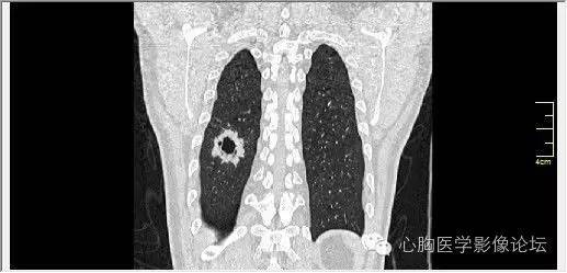 【病例】空腔型肺癌1例CT影像诊断与分析 【病例】空腔型肺癌1例CT影像诊断与分析