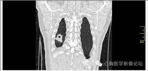 【病例】空腔型肺癌1例CT影像诊断与分析 【病例】空腔型肺癌1例CT影像诊断与分析