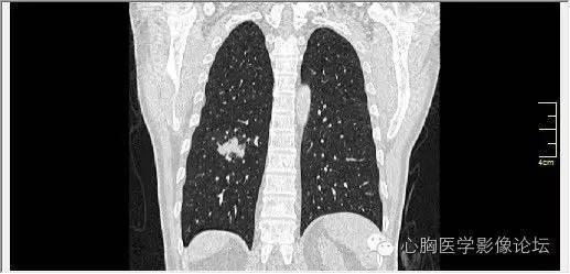 【病例】空腔型肺癌1例CT影像诊断与分析 【病例】空腔型肺癌1例CT影像诊断与分析
