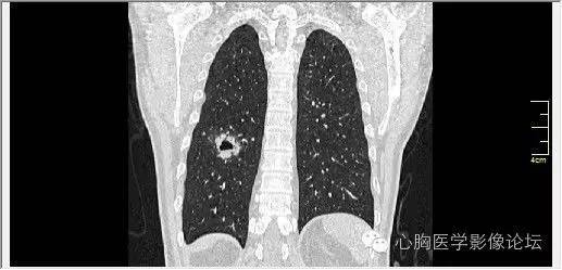 【病例】空腔型肺癌1例CT影像诊断与分析 【病例】空腔型肺癌1例CT影像诊断与分析