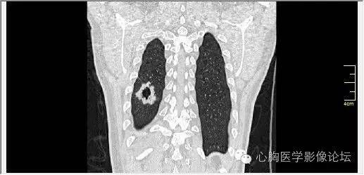 【病例】空腔型肺癌1例CT影像诊断与分析 【病例】空腔型肺癌1例CT影像诊断与分析