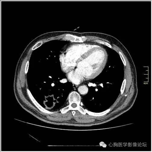 【病例】空腔型肺癌1例CT影像诊断与分析 【病例】空腔型肺癌1例CT影像诊断与分析