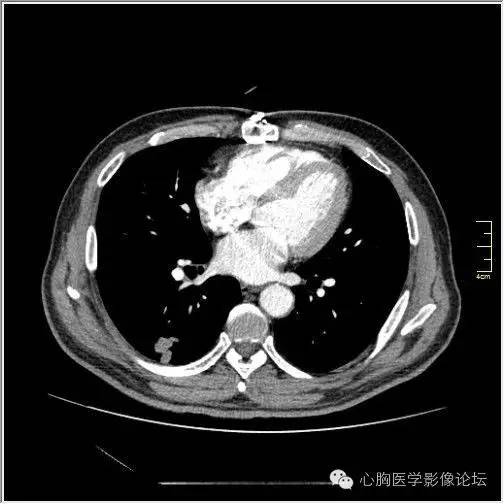 【病例】空腔型肺癌1例CT影像诊断与分析 【病例】空腔型肺癌1例CT影像诊断与分析