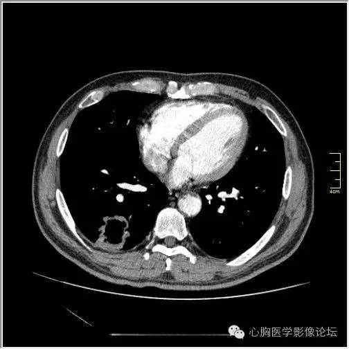 【病例】空腔型肺癌1例CT影像诊断与分析 【病例】空腔型肺癌1例CT影像诊断与分析