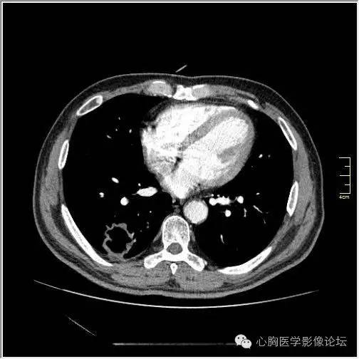 【病例】空腔型肺癌1例CT影像诊断与分析 【病例】空腔型肺癌1例CT影像诊断与分析