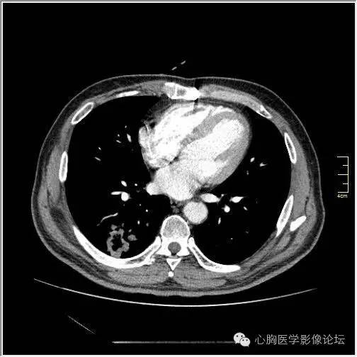 【病例】空腔型肺癌1例CT影像诊断与分析 【病例】空腔型肺癌1例CT影像诊断与分析