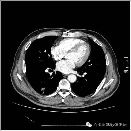 【病例】空腔型肺癌1例CT影像诊断与分析 【病例】空腔型肺癌1例CT影像诊断与分析