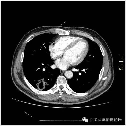 【病例】空腔型肺癌1例CT影像诊断与分析 【病例】空腔型肺癌1例CT影像诊断与分析
