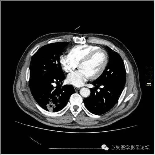 【病例】空腔型肺癌1例CT影像诊断与分析 【病例】空腔型肺癌1例CT影像诊断与分析