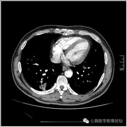 【病例】空腔型肺癌1例CT影像诊断与分析 【病例】空腔型肺癌1例CT影像诊断与分析