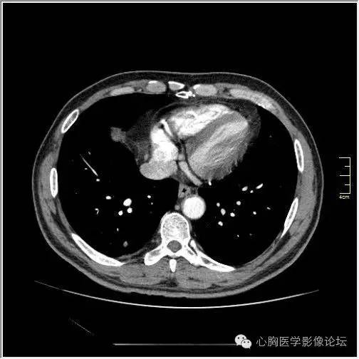 【病例】空腔型肺癌1例CT影像诊断与分析 【病例】空腔型肺癌1例CT影像诊断与分析