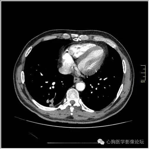 【病例】空腔型肺癌1例CT影像诊断与分析 【病例】空腔型肺癌1例CT影像诊断与分析