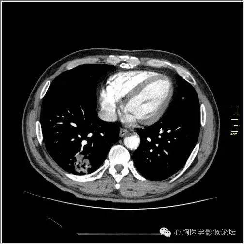 【病例】空腔型肺癌1例CT影像诊断与分析 【病例】空腔型肺癌1例CT影像诊断与分析