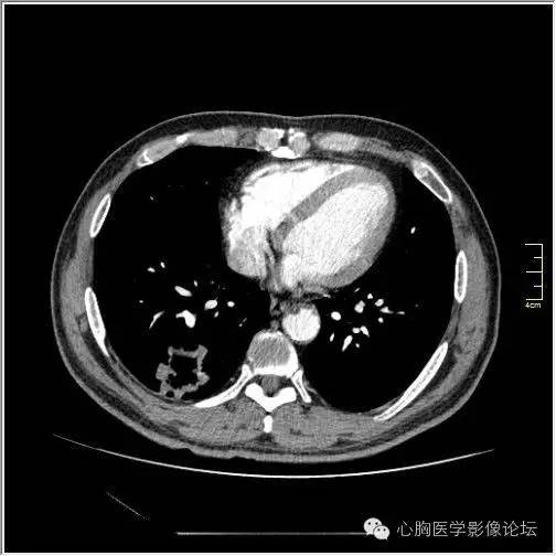 【病例】空腔型肺癌1例CT影像诊断与分析 【病例】空腔型肺癌1例CT影像诊断与分析