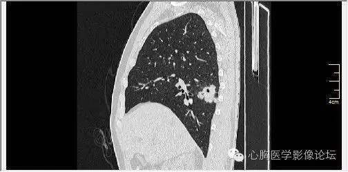 【病例】空腔型肺癌1例CT影像诊断与分析 【病例】空腔型肺癌1例CT影像诊断与分析