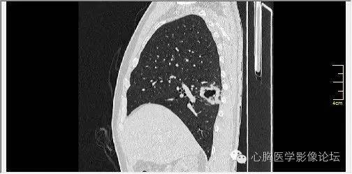 【病例】空腔型肺癌1例CT影像诊断与分析 【病例】空腔型肺癌1例CT影像诊断与分析