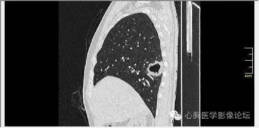 【病例】空腔型肺癌1例CT影像诊断与分析 【病例】空腔型肺癌1例CT影像诊断与分析