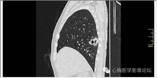 【病例】空腔型肺癌1例CT影像诊断与分析 【病例】空腔型肺癌1例CT影像诊断与分析