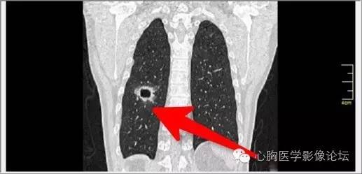 【病例】空腔型肺癌1例CT影像诊断与分析 【病例】空腔型肺癌1例CT影像诊断与分析