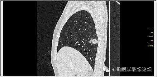【病例】空腔型肺癌1例CT影像诊断与分析 【病例】空腔型肺癌1例CT影像诊断与分析