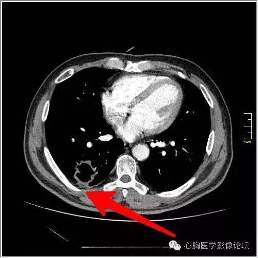 【病例】空腔型肺癌1例CT影像诊断与分析 【病例】空腔型肺癌1例CT影像诊断与分析