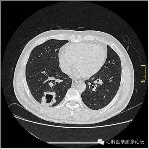 【病例】空腔型肺癌1例CT影像诊断与分析 【病例】空腔型肺癌1例CT影像诊断与分析