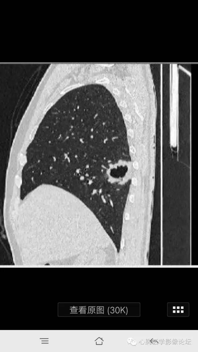 【病例】空腔型肺癌1例CT影像诊断与分析 【病例】空腔型肺癌1例CT影像诊断与分析