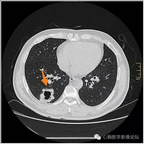 【病例】空腔型肺癌1例CT影像诊断与分析 【病例】空腔型肺癌1例CT影像诊断与分析