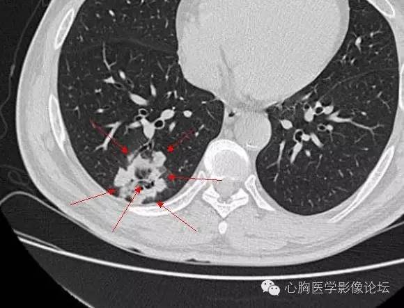 【病例】空腔型肺癌1例CT影像诊断与分析 【病例】空腔型肺癌1例CT影像诊断与分析