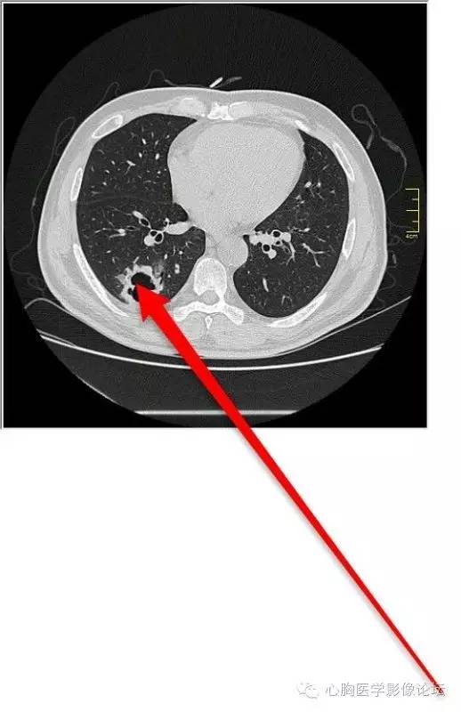 【病例】空腔型肺癌1例CT影像诊断与分析 【病例】空腔型肺癌1例CT影像诊断与分析