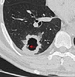 【病例】空腔型肺癌1例CT影像诊断与分析 【病例】空腔型肺癌1例CT影像诊断与分析
