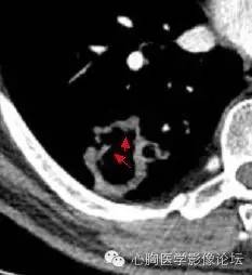 【病例】空腔型肺癌1例CT影像诊断与分析 【病例】空腔型肺癌1例CT影像诊断与分析