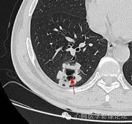 【病例】空腔型肺癌1例CT影像诊断与分析 【病例】空腔型肺癌1例CT影像诊断与分析