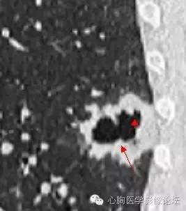 【病例】空腔型肺癌1例CT影像诊断与分析 【病例】空腔型肺癌1例CT影像诊断与分析