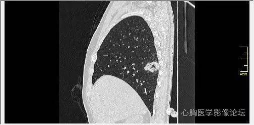 【病例】空腔型肺癌1例CT影像诊断与分析 【病例】空腔型肺癌1例CT影像诊断与分析