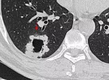 【病例】空腔型肺癌1例CT影像诊断与分析 【病例】空腔型肺癌1例CT影像诊断与分析