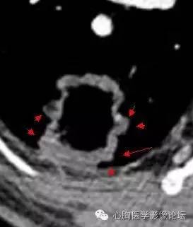 【病例】空腔型肺癌1例CT影像诊断与分析 【病例】空腔型肺癌1例CT影像诊断与分析