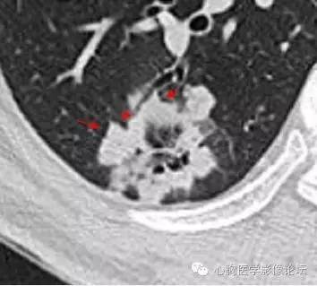【病例】空腔型肺癌1例CT影像诊断与分析 【病例】空腔型肺癌1例CT影像诊断与分析