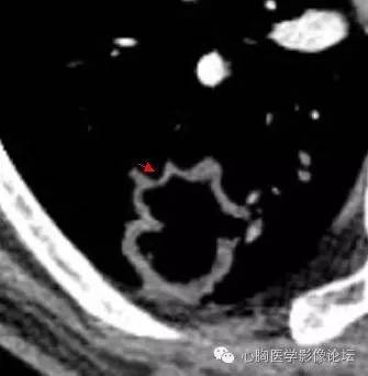 【病例】空腔型肺癌1例CT影像诊断与分析 【病例】空腔型肺癌1例CT影像诊断与分析