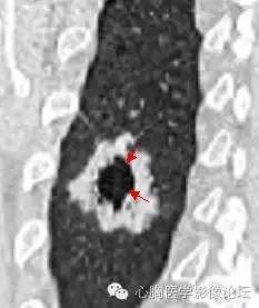 【病例】空腔型肺癌1例CT影像诊断与分析 【病例】空腔型肺癌1例CT影像诊断与分析