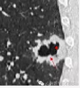 【病例】空腔型肺癌1例CT影像诊断与分析 【病例】空腔型肺癌1例CT影像诊断与分析